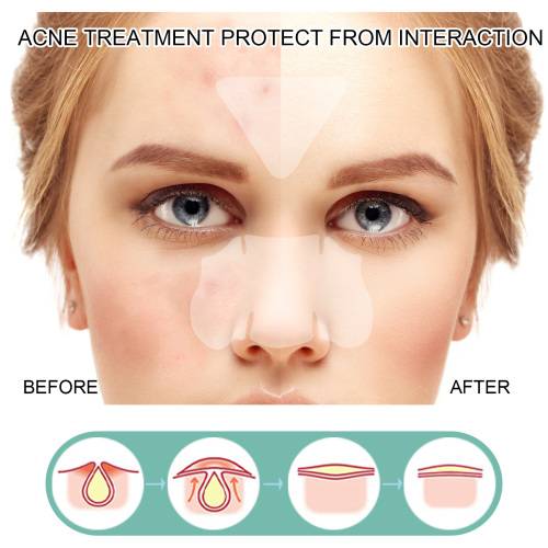 Gentle Pimple Cover Patches