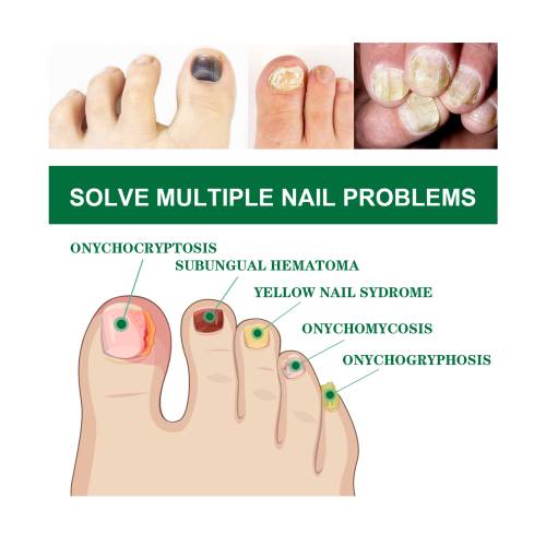 Mugwort Toenail Essence