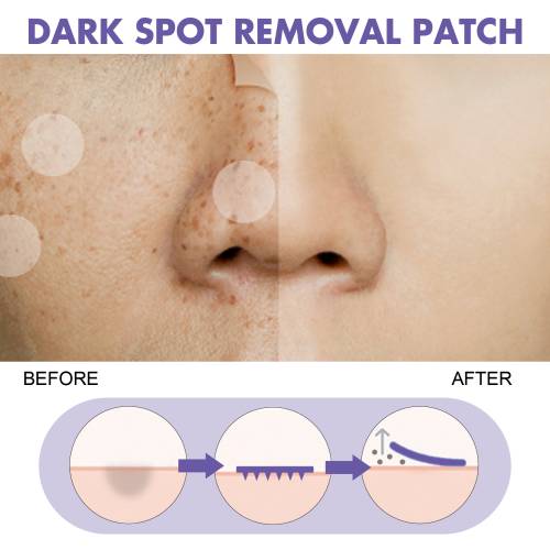Dark Spot Patches with Niacinamide & Vitamin C