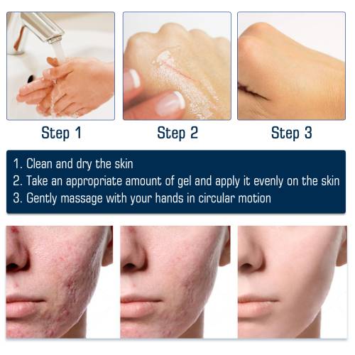Silicone Scar Gel