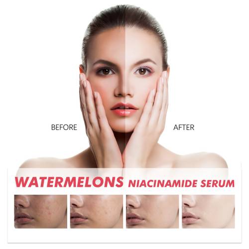 Watermelon Niacinamide Face Serum