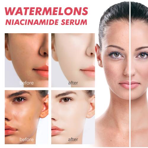 Watermelon Niacinamide Face Serum