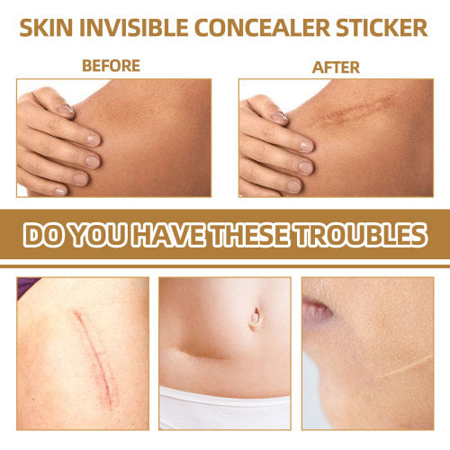 Skin Tone Concealer Patches, Waterproof