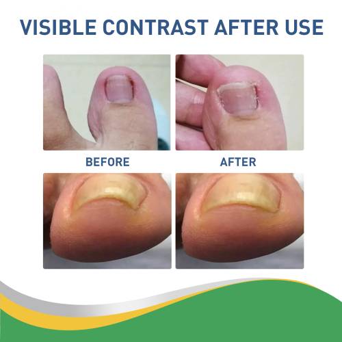 Toenail Edge Patches