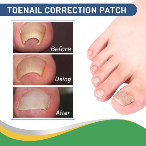 Toenail Edge Patches