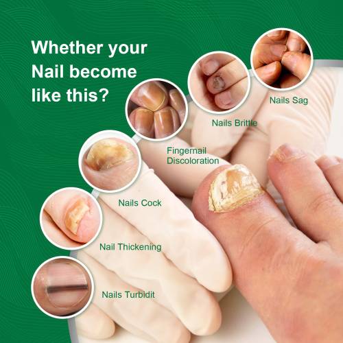 Mugwort Toenail Essence