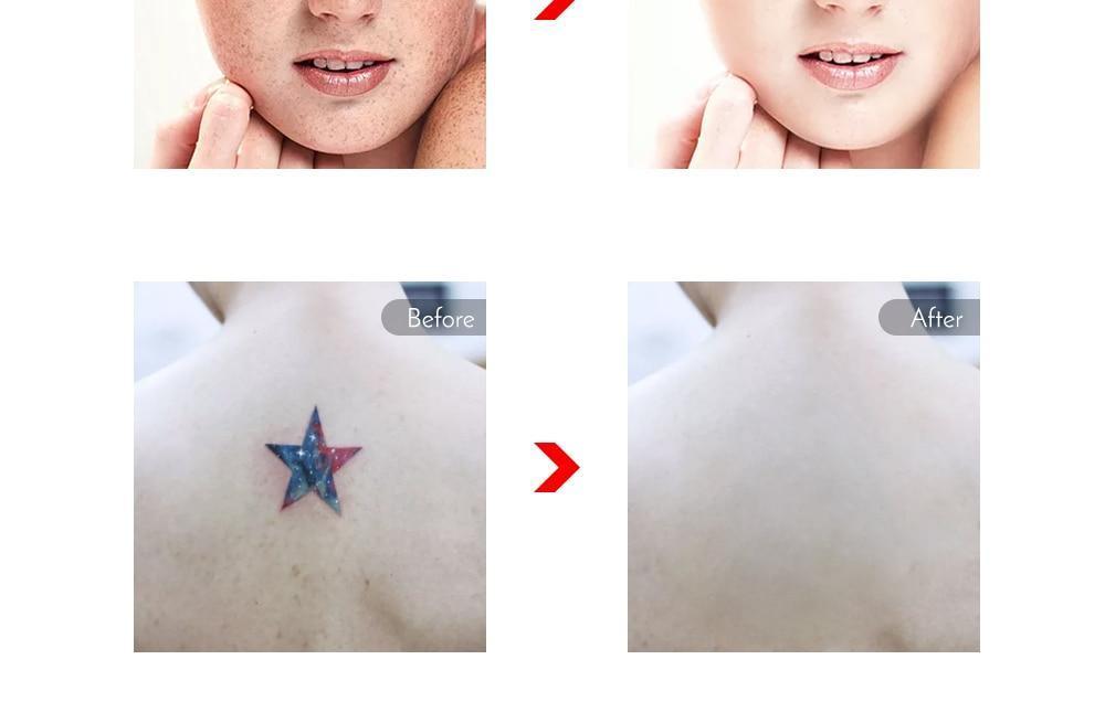 Professional Laser Pen Tattoo Removal, Mole, Freckles, Acne removal